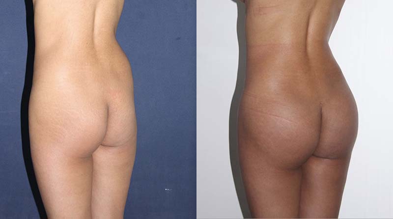 fotos implantes oblicuos posteriores